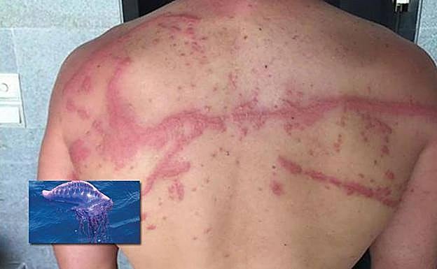 Así se le ha quedado la espalda al reportero de Telecinco tras la picadura