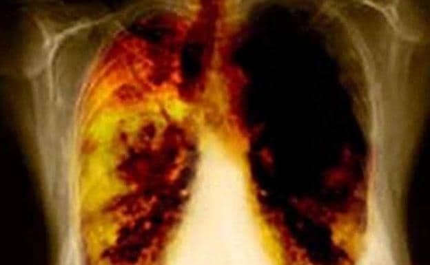 El gas radón interior y el cáncer de pulmón en personas no fumadoras