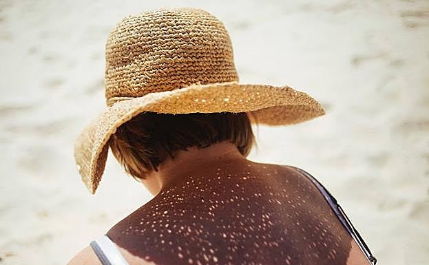 ¿Cómo vivir el verano con una alergia al sol?