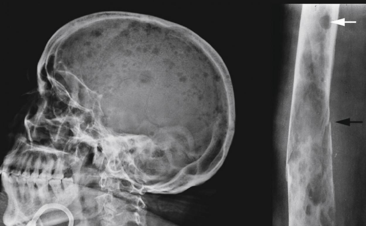 Mieloma múltiple: el cáncer invisible