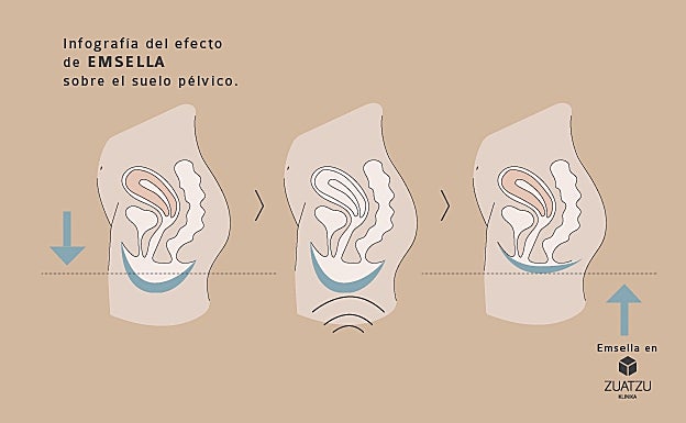Infografía del efecto de EMSELLA sobre el suelo pélvico.