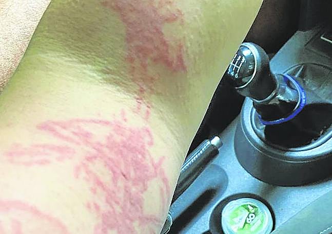 Así quedó el brazo de Arantza tras las picaduras.