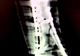Ondas de choque para estimular la consolidación de fracturas óseas