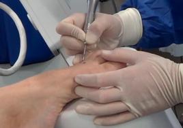 Una pequeña cirugía sin incisión para acabar con la metatarsalgia