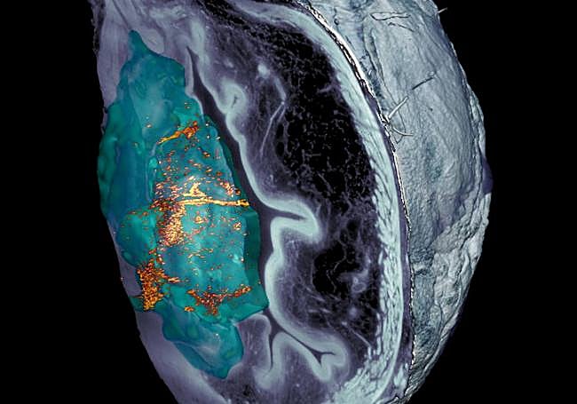 Acumulación de nanorrobots en el tumor.