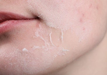 Una dermatóloga vasca avisa de los efectos de un conocido producto cosmético: «Tu piel puede descamarse»