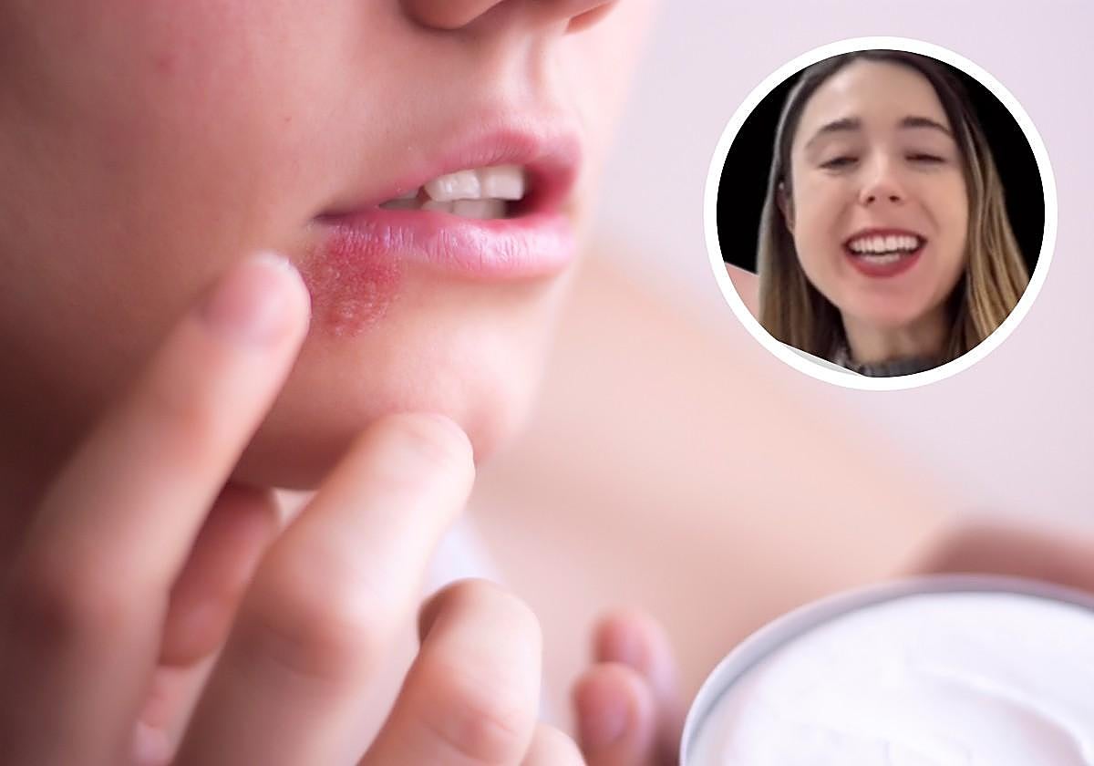 Una dermatóloga vasca alerta sobre los remedios caseros para tratar el herpes: «Pueden aumentar la inflamación y dejar marca».