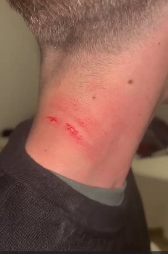Detalle de las lesiones sufridas en el cuello por el menor de 16 años.