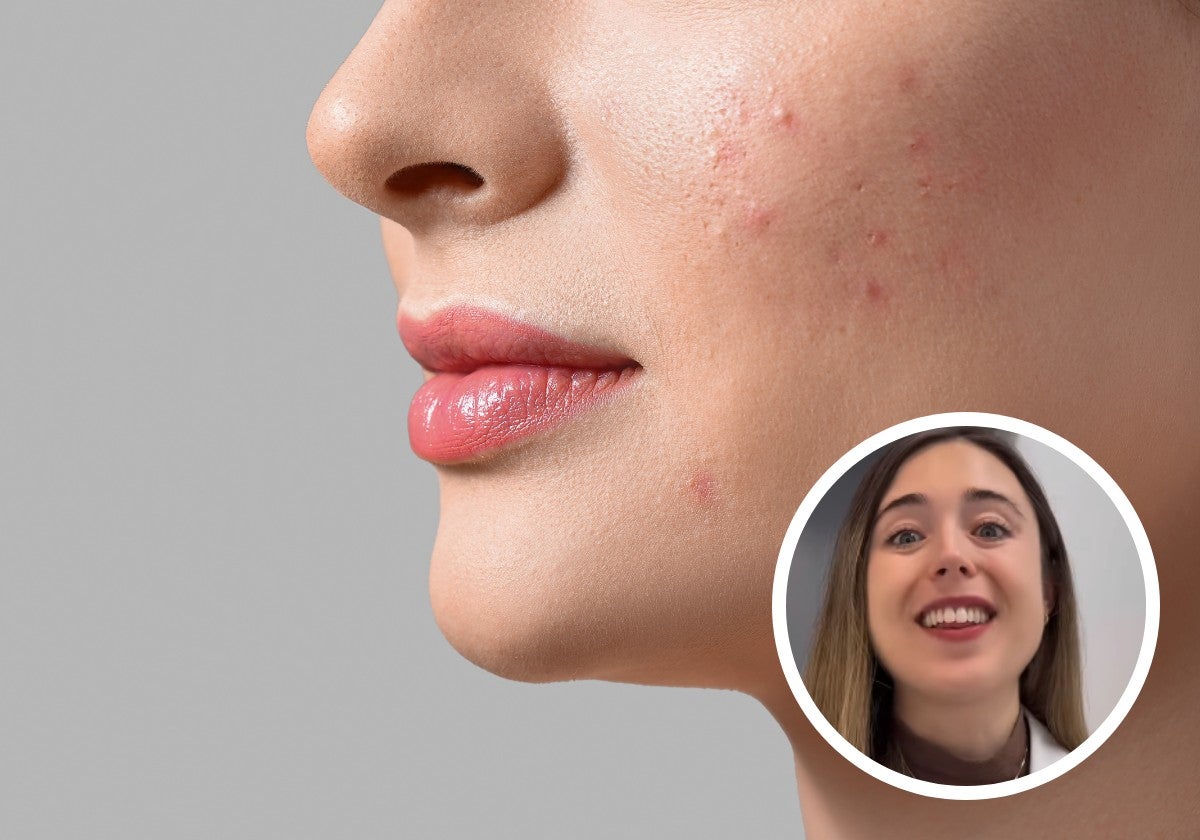 Una dermatóloga vasca explica los tres errores al tratar el acné: «Lo primero a evitar es tomar proteína derivada de la leche de vaca»
