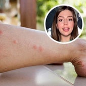 La explicación científica que aclara por qué hay personas que sufren más las picaduras de mosquitos: «Sudan y tienen más papeletas»
