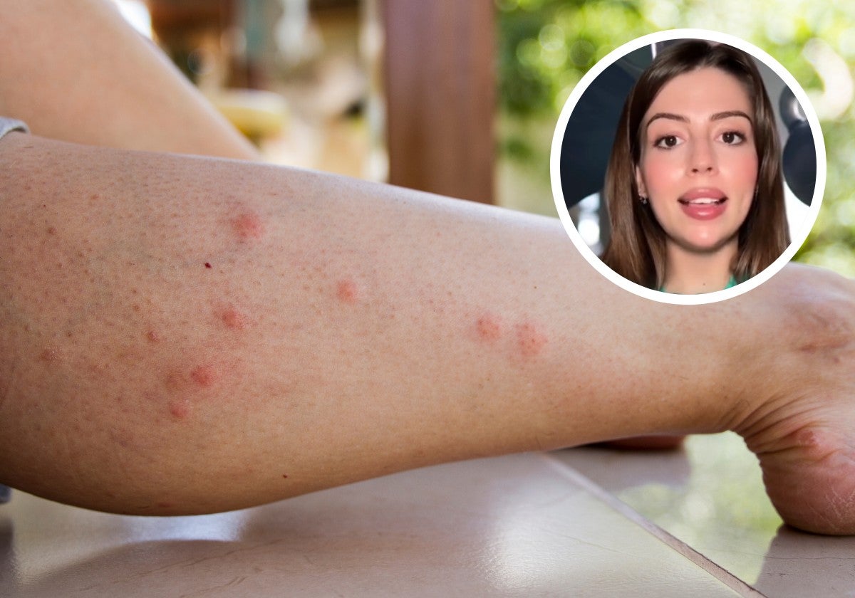 La explicación científica que aclara por qué hay personas que sufren más las picaduras de mosquitos: «Sudan y tienen más papeletas»