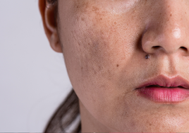 Los tres consejos de una dermatóloga vasca para evitar que las manchas de la piel empeoren en verano
