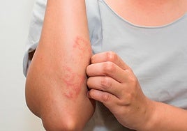 Intestino permeable: la raíz oculta de las enfermedades de la piel