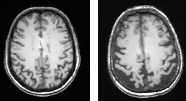 Morfología de un cerebro sano (izquierda) y uno con Alzhéimer (derecha).
