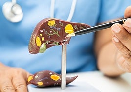 «La pérdida de peso es la clave para mejorar el hígado graso y el síndrome metabólico»