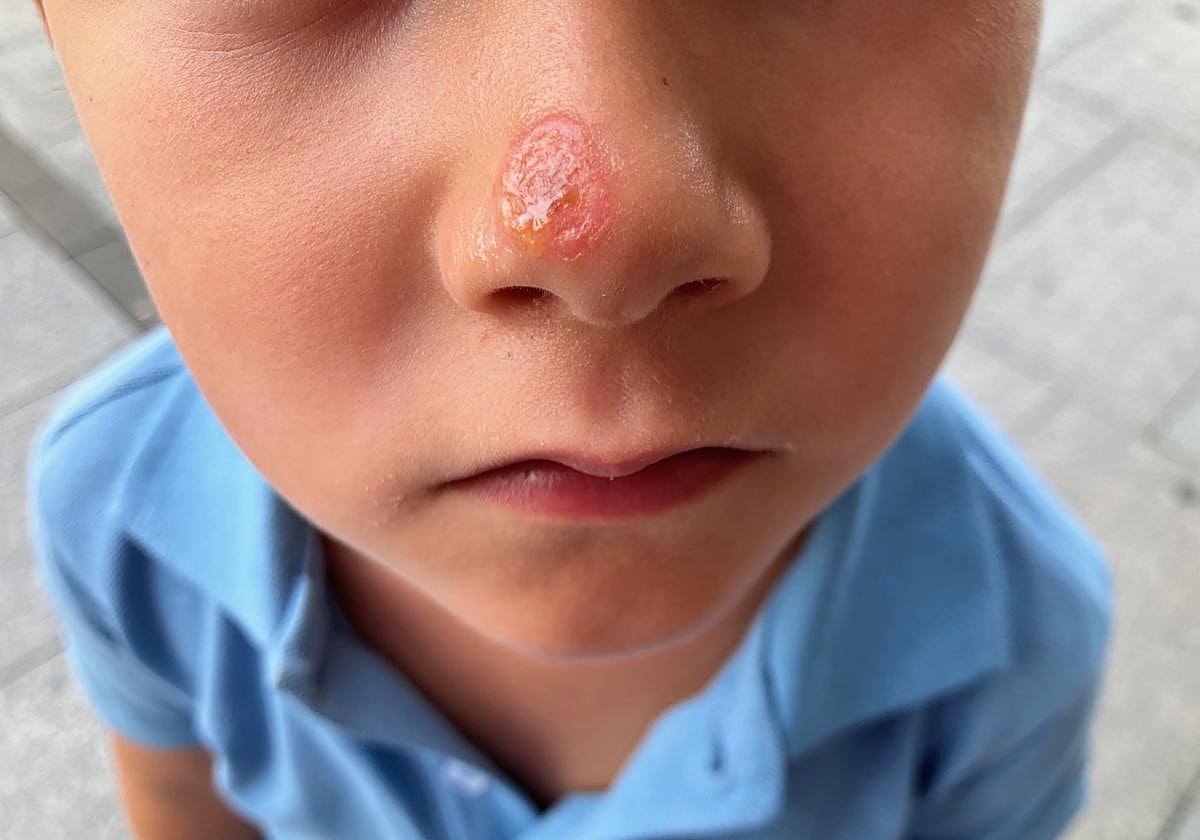 El impétigo, la infección cutánea que llena las consultas de Pediatría de Gipuzkoa en verano