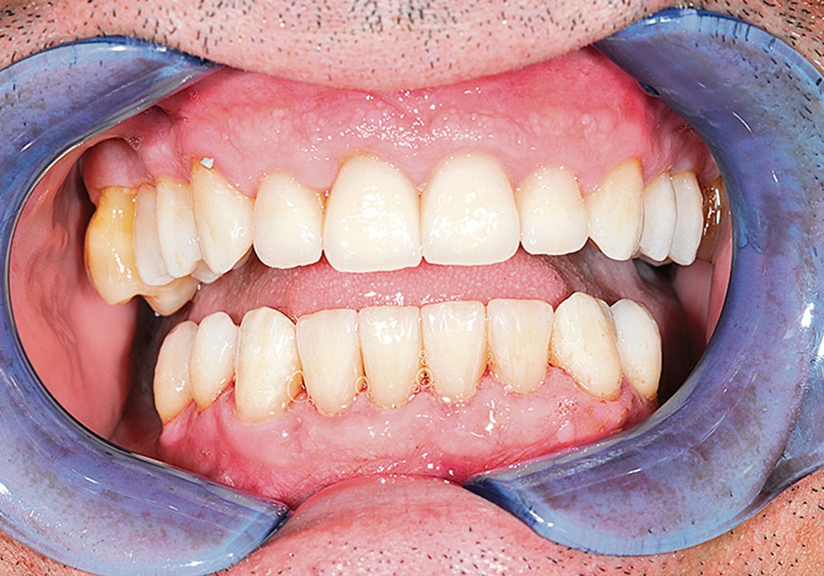 Imagen después - Tratamiento completo de la boca desde los dientes y las encías hasta el buen aliento