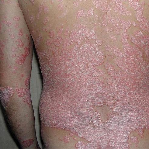 La psoriasis se manifiesta en la piel en forma de placas rosáceas que pican y se escaman. 