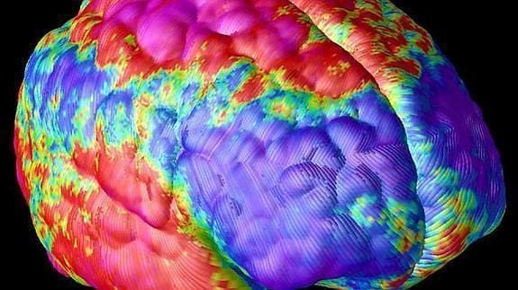 Imagen de una resonancia magnética del cerebro de un adolescente con esquizofrenia