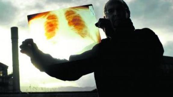 Afectado de asbestosis muestra una radiografía de sus pulmones dañados. 