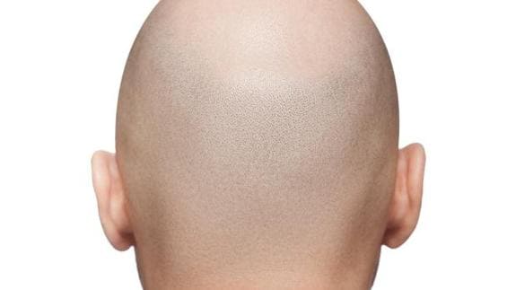Existen diferentes tratamientos para la alopecia.