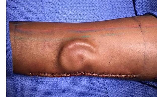 Imagen de la oreja de la soldad implantada en su brazo