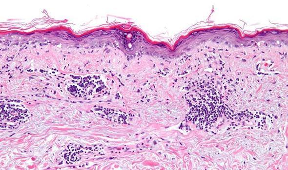 Lupus eritematoso sistémico