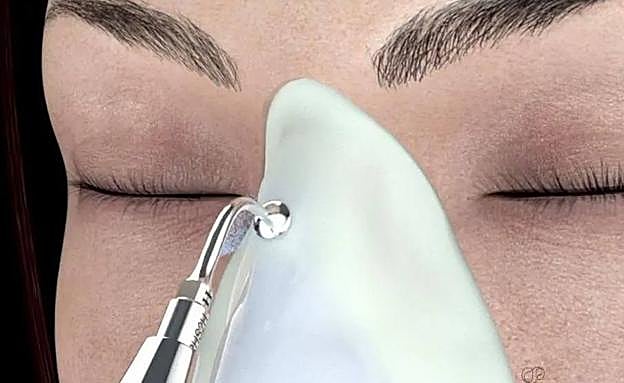 Bisturí piezo eléctrico para pulir y modelar la nariz de forma más precisa y con menor inflamación 