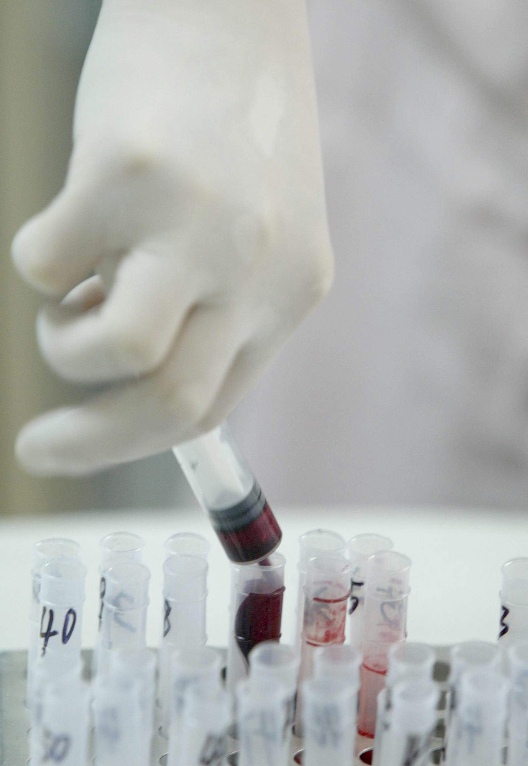 Una investigación permite detectar múltiples tipos de cáncer con un análisis de sangre.