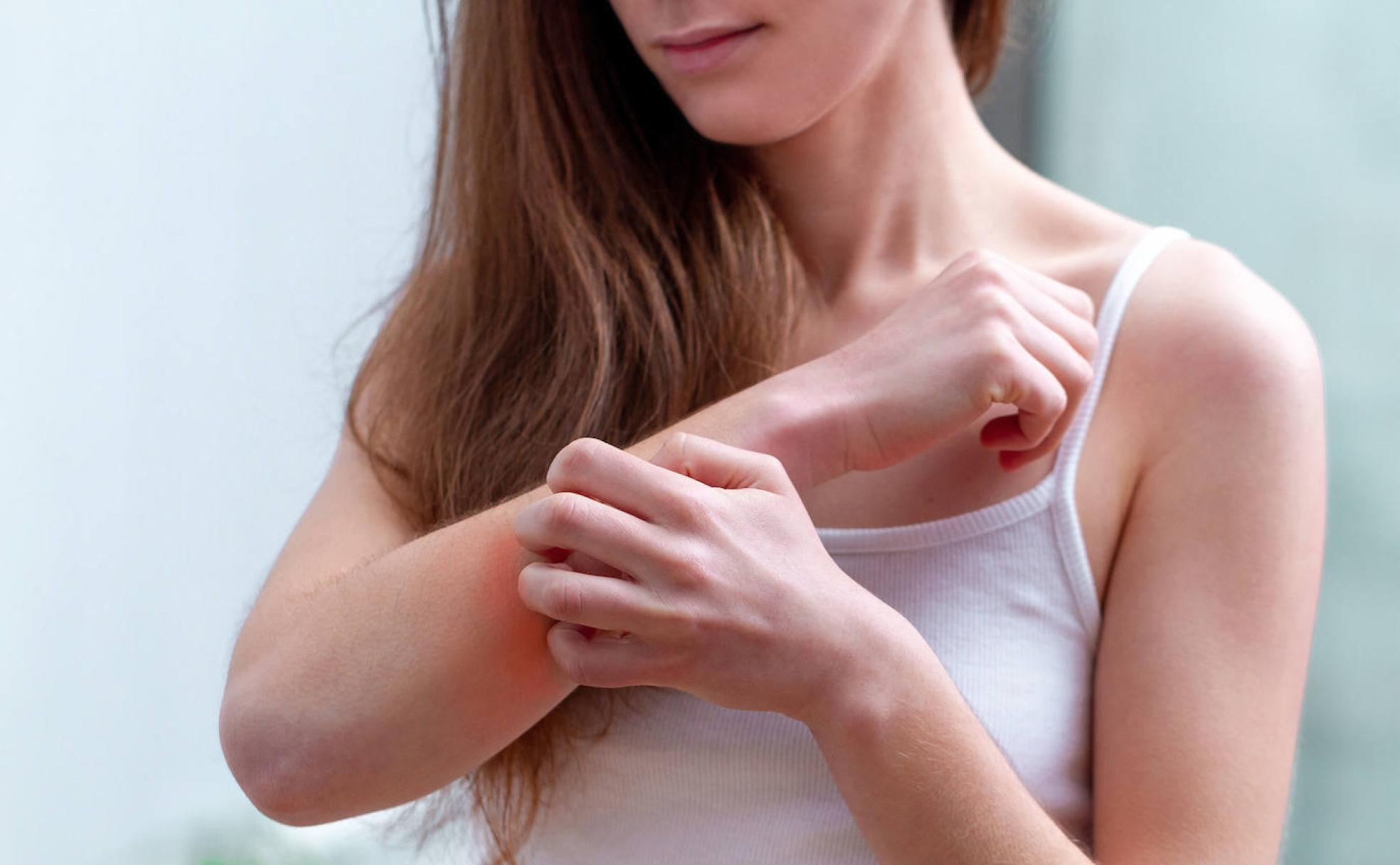 Más de dos millones de españoles padecen dermatitis atópica 