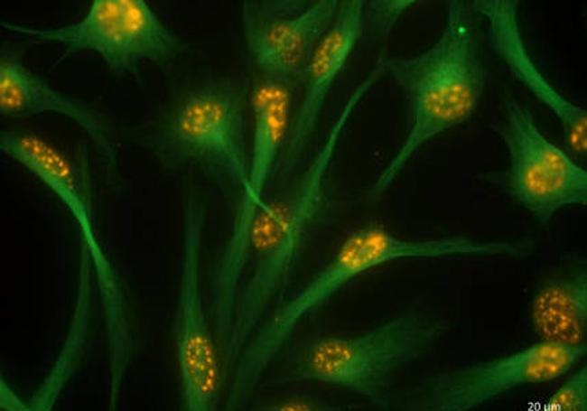 Imagen de una microscopía de fluorescencia de un cultivo de células madre de glioblastoma del subtipo mesenquimal derivadas de pacientes donde se observa la localización de la proteína SMAD3, la cual parece tener un rol clave en su desarrollo.