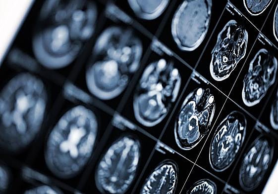 Condenan al Sespa a pagar 36.910 euros por no detectar un tumor cerebral