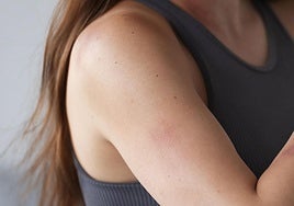 ¿Qué son los granitos que salen en los brazos y cómo tratarlos?