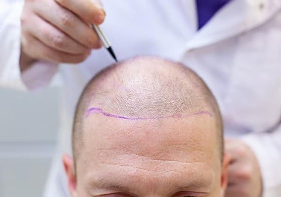 Martyn Latchman falleció en Estambul tras sentirse mal antes de someterse a una cirugía capilar