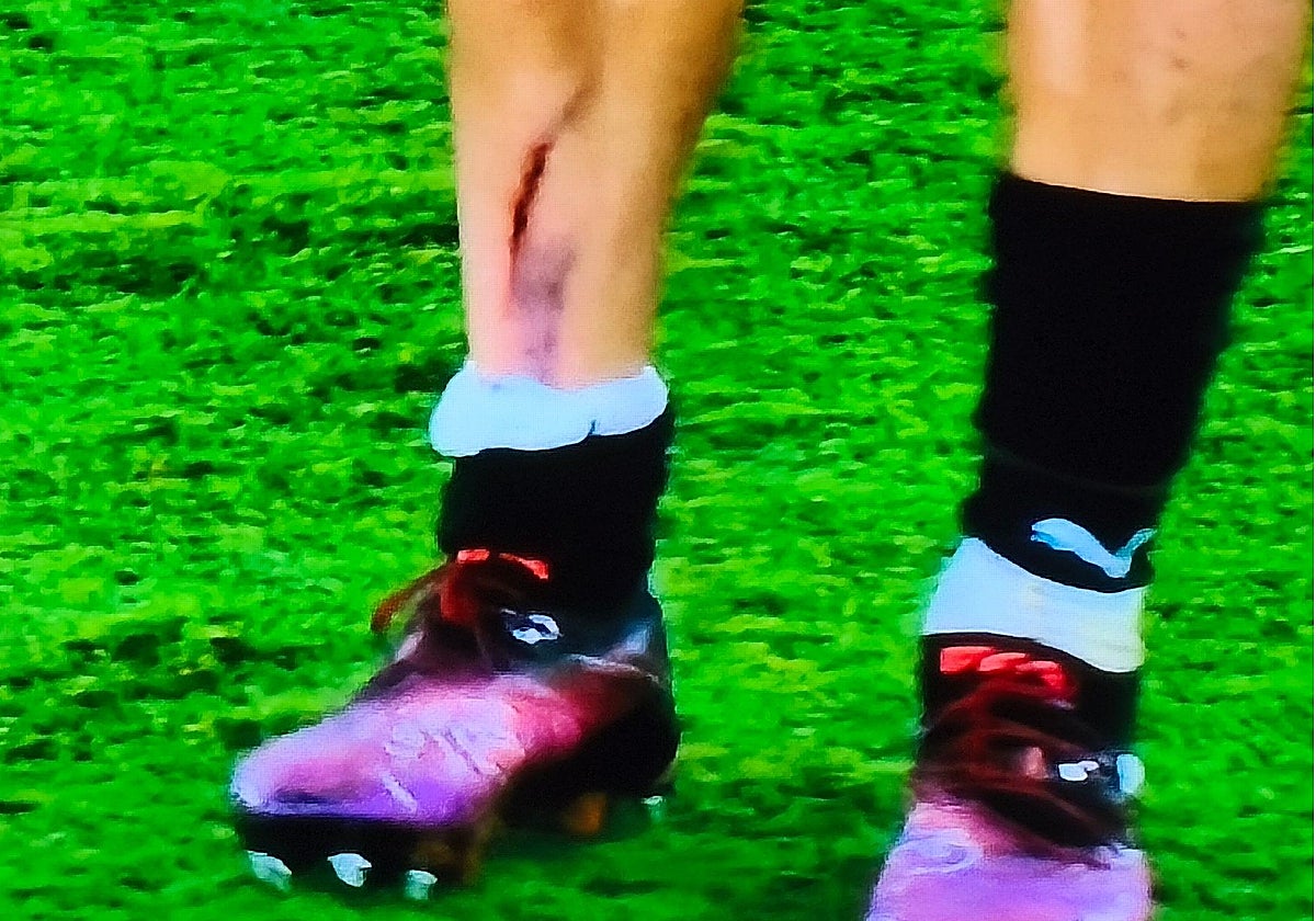 Así quedó la pierna derecha de Kevin, que fue amonestado, tras la dura entrada de Thalys.