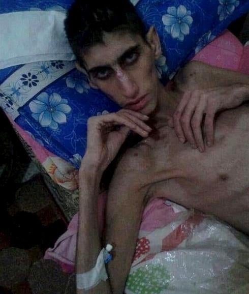 Un hombre desnutrido en Madaya. 