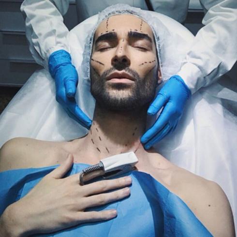 Miguel Vilas, de Gran Hermano 17, se somete a una operación de cirugía estética para poder llegar a fin de mes