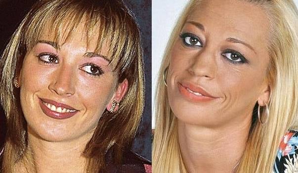 Belén Esteban, antes y después de operarse. 