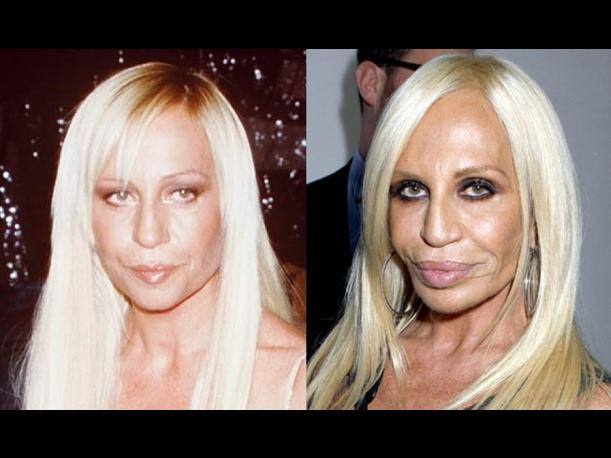 Donatella Versage, antes y después de operarse. 