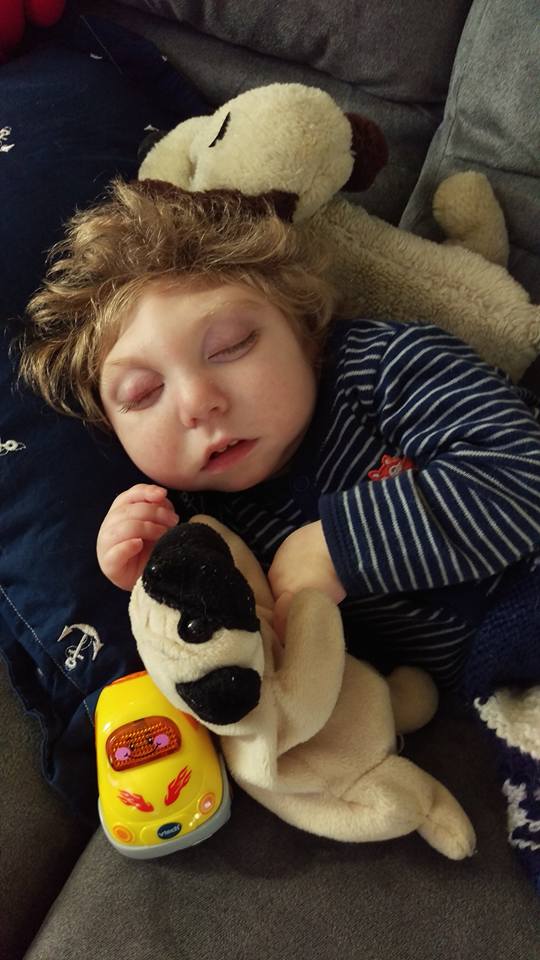 Así vive Jaxon, un niño con microcefalia