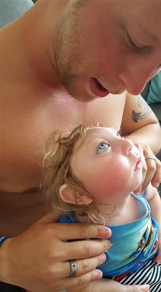 Así vive Jaxon, un niño con microcefalia