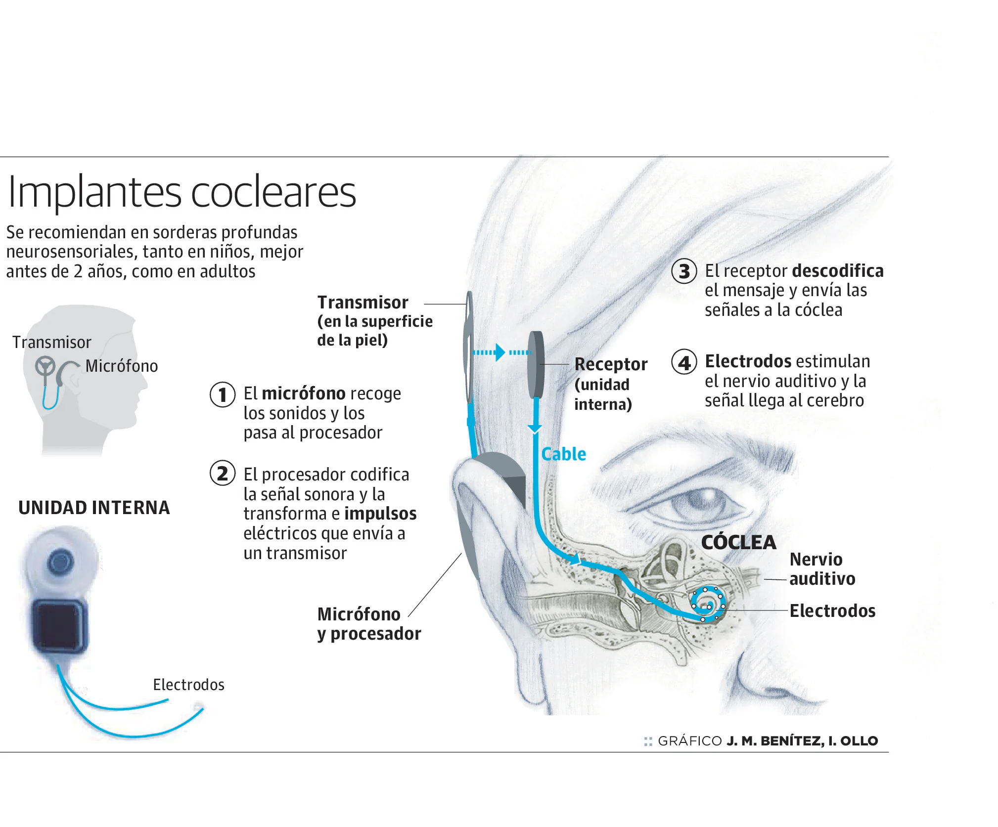 Fotos: Implantes cocleares