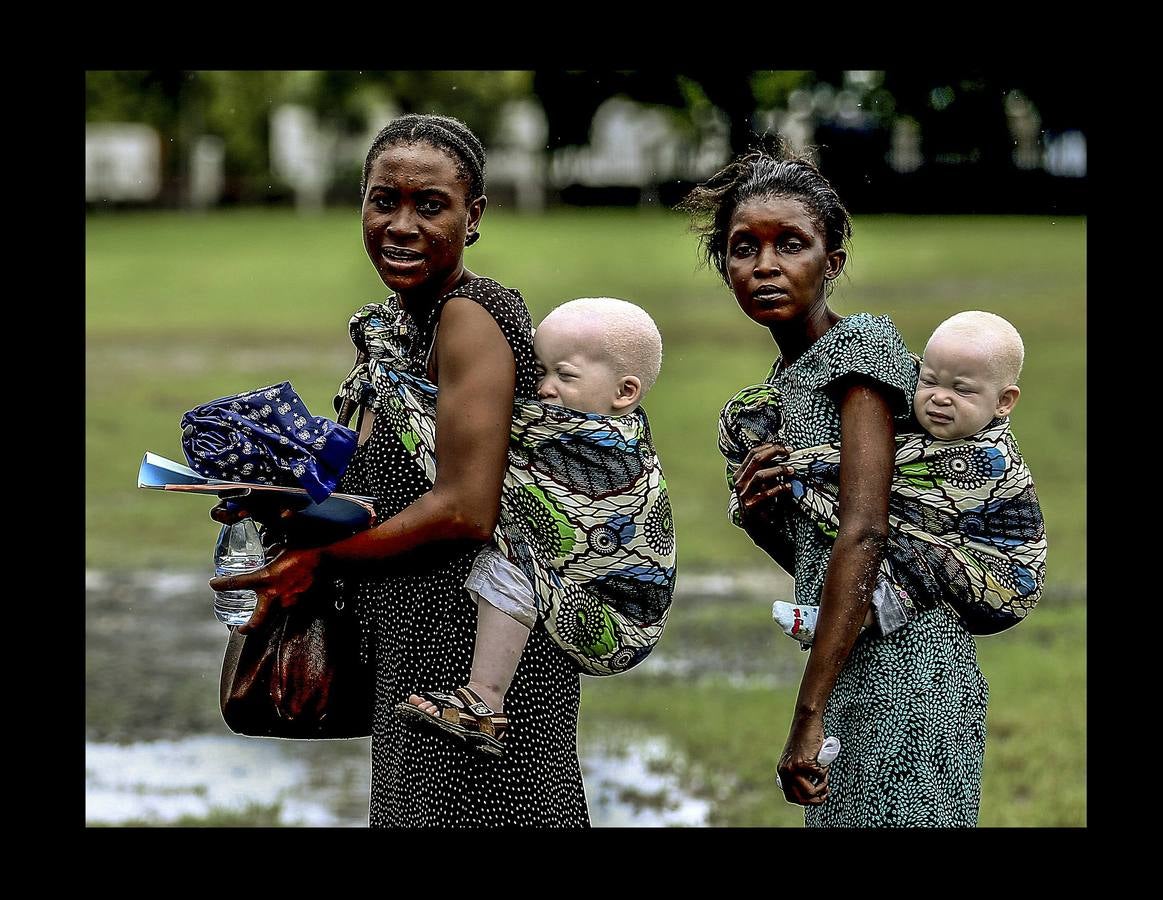 Son un tabú y una maldición para las familias y se les considera menos que humanos. En algunos países de África Oriental padecer albinismo, un trastorno genético que produce la ausencia total o parcial de pigmentación en la piel, equivale a ser un apestado y estar condenado a muerte. Según ciertas supersticiones el cuerpo de los albinos atrae la buena suerte y es un poderoso talismán. Por esta razón, en zonas rurales de Tanzania (donde están tomadas las fotografías), es frecuente el asesinato para comerciar con partes de sus cuerpos con los que elaborar conjuros y elixires. En los últimos tiempos alrededor de 10.000 albinos han tenido que escapar de su país.