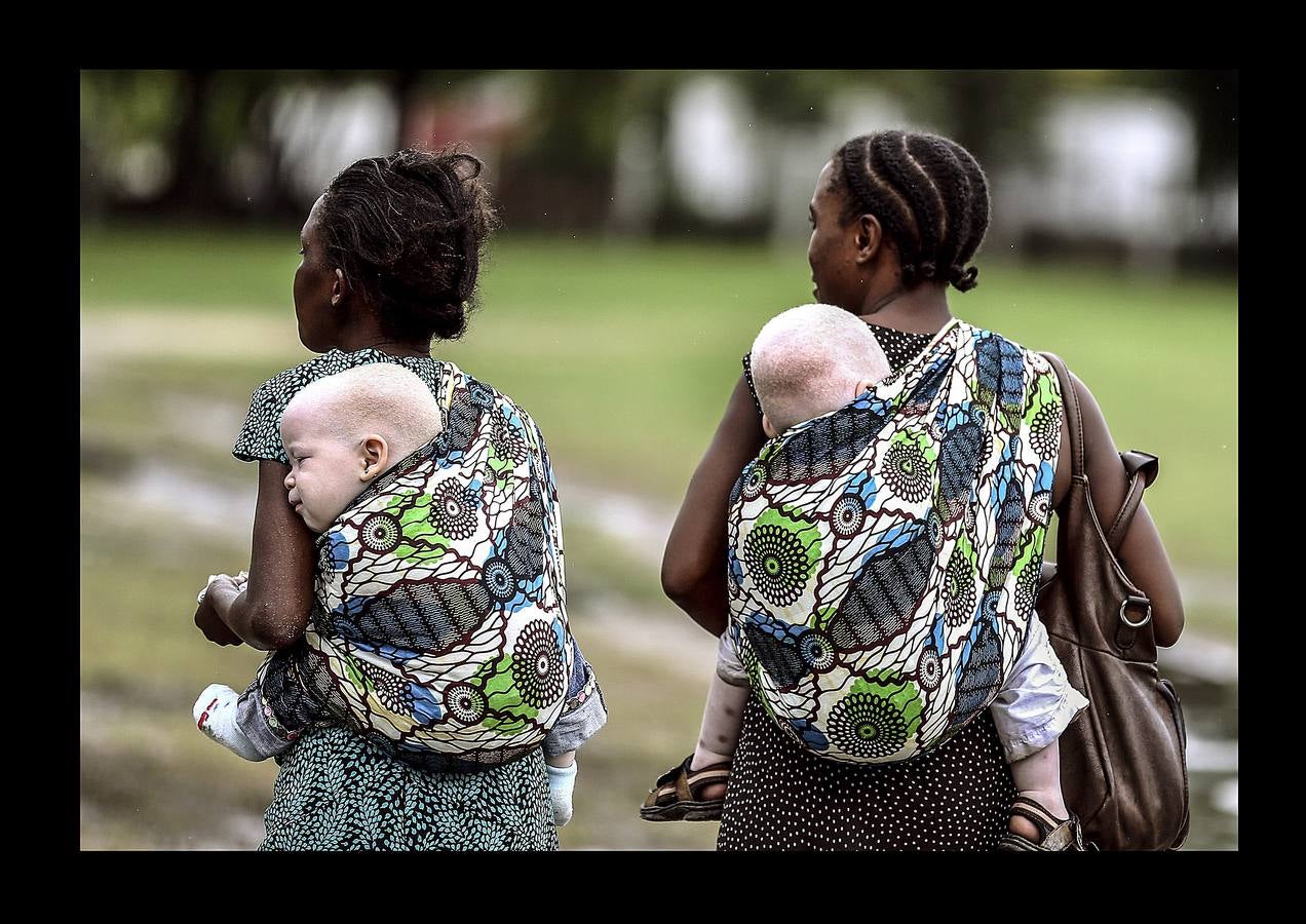 Son un tabú y una maldición para las familias y se les considera menos que humanos. En algunos países de África Oriental padecer albinismo, un trastorno genético que produce la ausencia total o parcial de pigmentación en la piel, equivale a ser un apestado y estar condenado a muerte. Según ciertas supersticiones el cuerpo de los albinos atrae la buena suerte y es un poderoso talismán. Por esta razón, en zonas rurales de Tanzania (donde están tomadas las fotografías), es frecuente el asesinato para comerciar con partes de sus cuerpos con los que elaborar conjuros y elixires. En los últimos tiempos alrededor de 10.000 albinos han tenido que escapar de su país.