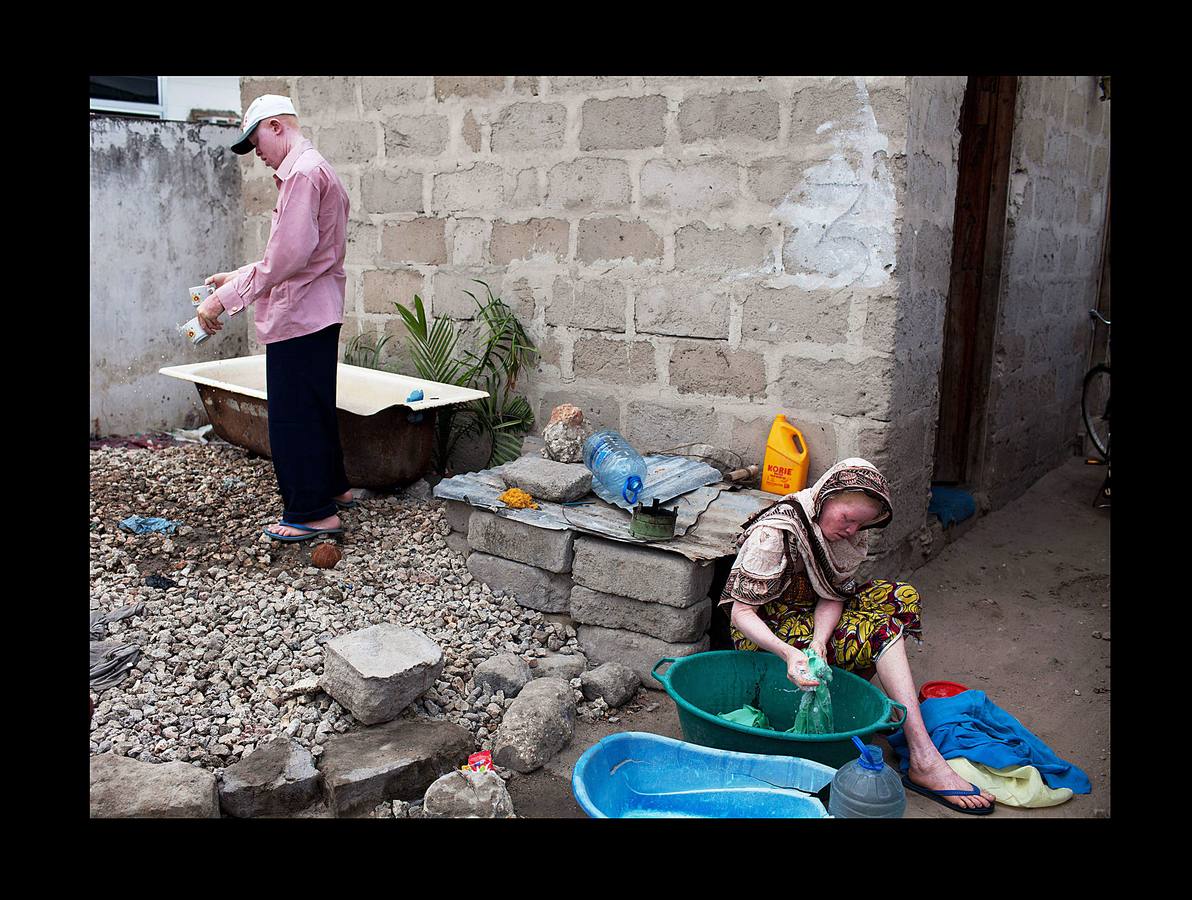 Son un tabú y una maldición para las familias y se les considera menos que humanos. En algunos países de África Oriental padecer albinismo, un trastorno genético que produce la ausencia total o parcial de pigmentación en la piel, equivale a ser un apestado y estar condenado a muerte. Según ciertas supersticiones el cuerpo de los albinos atrae la buena suerte y es un poderoso talismán. Por esta razón, en zonas rurales de Tanzania (donde están tomadas las fotografías), es frecuente el asesinato para comerciar con partes de sus cuerpos con los que elaborar conjuros y elixires. En los últimos tiempos alrededor de 10.000 albinos han tenido que escapar de su país.