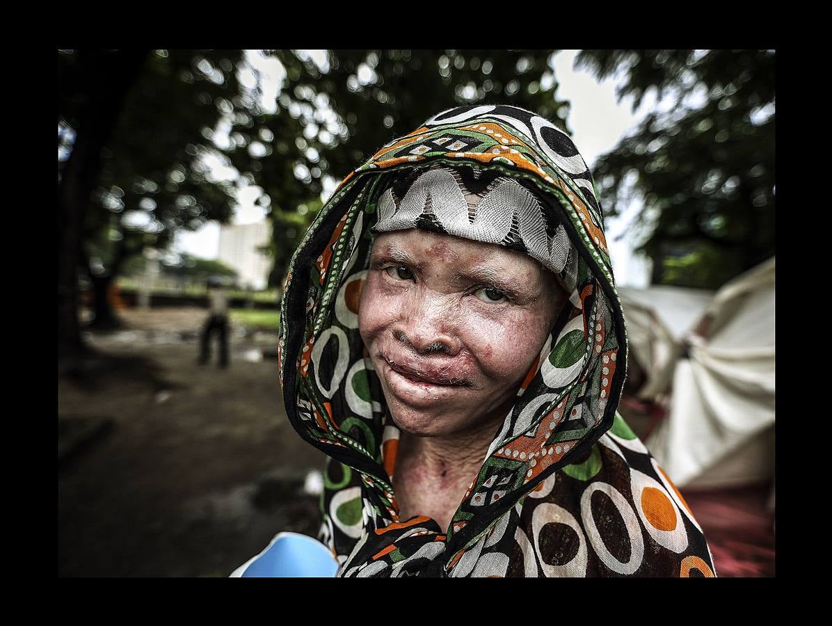 Son un tabú y una maldición para las familias y se les considera menos que humanos. En algunos países de África Oriental padecer albinismo, un trastorno genético que produce la ausencia total o parcial de pigmentación en la piel, equivale a ser un apestado y estar condenado a muerte. Según ciertas supersticiones el cuerpo de los albinos atrae la buena suerte y es un poderoso talismán. Por esta razón, en zonas rurales de Tanzania (donde están tomadas las fotografías), es frecuente el asesinato para comerciar con partes de sus cuerpos con los que elaborar conjuros y elixires. En los últimos tiempos alrededor de 10.000 albinos han tenido que escapar de su país.