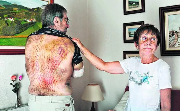 Mari Carmen muestra los numeroros cortes y moratones que Simón, su marido, sufrió en la espalda. 