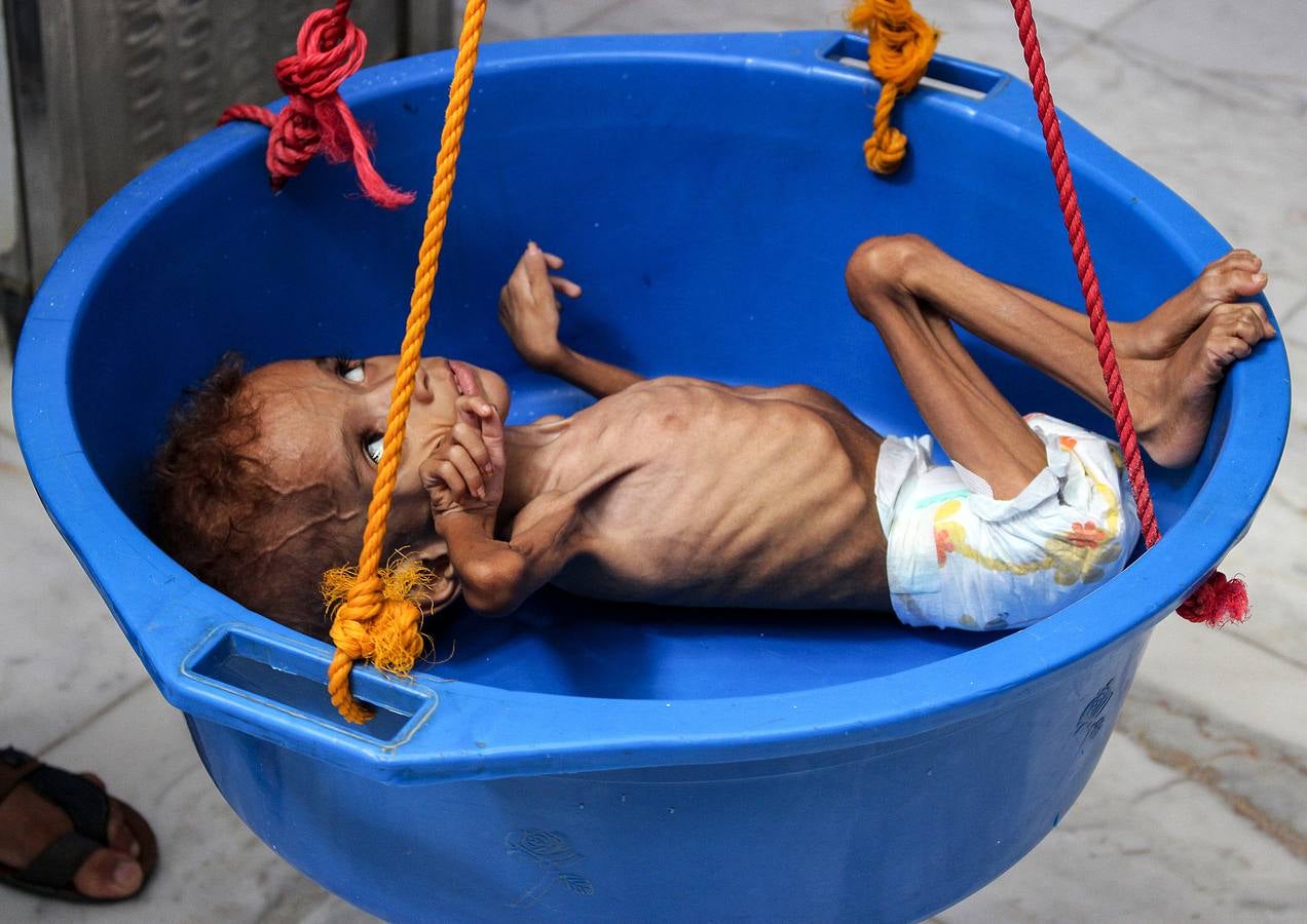 Bassem Mohamed Hassan, un niño yemení de dos años que sufre de desnutrición, en un hospital en el distrito norte de Abs en la provincia noroeste de Hajjah, en el noroeste de Yemen.