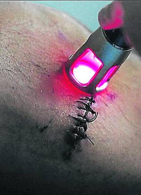 Imagen - Detalle de la herida de Duarte. E. C. 