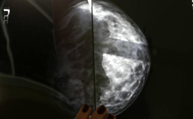 Mamografía.